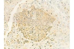 ABIN6264758 and ABIN6279799 at 1/100 staining human esophageal carcinoma by IHC-P.