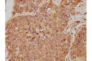 IHC image of ABIN7144729 diluted at 1:250 and staining in paraffin-embedded human liver cancer performed on a Leica BondTM system. (GOT1 antibody  (AA 2-411))