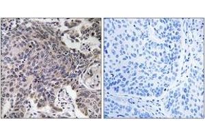 Immunohistochemistry analysis of paraffin-embedded human lung carcinoma tissue, using MRPL54 Antibody. (MRPL54 antibody  (AA 81-130))