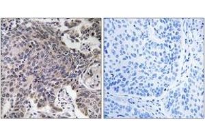 Immunohistochemistry analysis of paraffin-embedded human lung carcinoma tissue, using MRPL54 Antibody. (MRPL54 antibody  (AA 81-130))