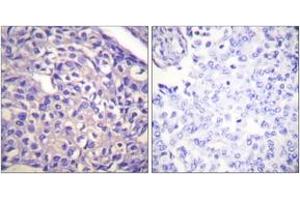 Immunohistochemistry analysis of paraffin-embedded human breast carcinoma tissue, using MYPT1 (Ab-696) Antibody. (PPP1R12A antibody  (AA 661-710))