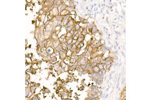 Immunohistochemistry of paraffin-embedded Human lung squamous carcinoma tissue using TROP-2 antibody (ABIN7271103) at dilution of 1:2700 (40x lens). (TACSTD2 antibody)