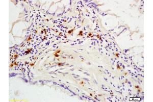 Formalin-fixed and paraffin embedded human colon carcinoma labeled with Rabbit Anti phospho-p53BP1(Ser25/29) Polyclonal Antibody, Unconjugated (ABIN682993) at 1:200 followed by conjugation to the secondary antibody and DAB staining (TP53BP1 antibody  (pSer25, pSer29))