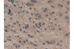 Detection of dSIP in Human Glioma Tissue using Polyclonal Antibody to Delta-Sleep Inducing Peptide (dSIP) (dSIP (AA 1-134) antibody)