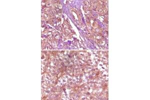 Immunohistochemical analysis of paraffin-embedded human pancreas carcinoma (upper) and breast carcinoma (bottom) tissue, showing membrane and cytoplasmic (pancreas carcinoma) localization, membrane (breast carcinoma) localization using EPHB4 monoclonal antibody, clone 5B8F7  with DAB staining.