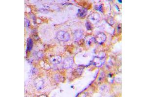 Immunohistochemical analysis of 4EBP1 staining in human lung cancer formalin fixed paraffin embedded tissue section. (eIF4EBP1 antibody  (N-Term))