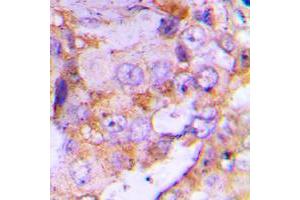Immunohistochemical analysis of 4EBP1 staining in human lung cancer formalin fixed paraffin embedded tissue section.
