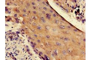 Immunohistochemistry of paraffin-embedded human cervical cancer using ABIN7142559 at dilution of 1:100