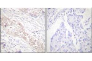 Immunohistochemistry analysis of paraffin-embedded human breast carcinoma, using Smad2 (Phospho-Ser467) Antibody. (SMAD2 antibody  (pSer467))