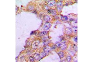 Immunohistochemical analysis of COX5B staining in human lung cancer formalin fixed paraffin embedded tissue section. (COX5B antibody  (N-Term))