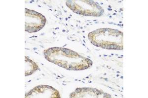 Immunohistochemistry of paraffin-embedded human gastric using NEDD4 antibody (ABIN1681009, ABIN3015207, ABIN3015208 and ABIN6213883) at dilution of 1:200 (40x lens). (NEDD4 antibody  (AA 160-460))