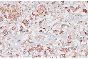 Immunohistochemistry of paraffin-embedded Human breast cancer using Desmoplakin Polyclonal Antibody at dilution of 1:100 (40x lens).