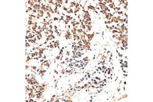 Immunohistochemistry of paraffin-embedded human lung cancer using MCM5 antibody. (MCM5 antibody  (AA 1-230))
