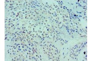 Immunohistochemistry of paraffin-embedded human breast cancer using ABIN7158577 at dilution of 1:100 (LRP6 antibody  (AA 20-150))