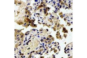 Immunohistochemical analysis of RPS20 staining in human lung cancer formalin fixed paraffin embedded tissue section. (RPS20 antibody)