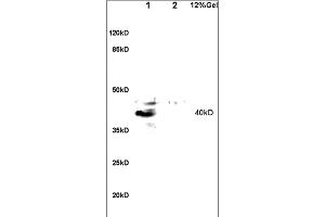 Formalin-fixed and paraffin embedded human lung carcinoma labeled with Anti-GPR15 Polyclonal Antibody, Unconjugated (ABIN702835) at 1:200 followed by conjugation to the secondary antibody and DAB staining. (GPR15 antibody  (AA 51-150))