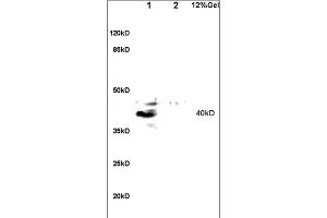 Formalin-fixed and paraffin embedded human lung carcinoma labeled with Anti-GPR15 Polyclonal Antibody, Unconjugated (ABIN702835) at 1:200 followed by conjugation to the secondary antibody and DAB staining.