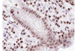ABIN6267628 at 1/100 staining human Stomach carcinoma tissue sections by IHC-P. (FOXO1/3/4-pan antibody  (pThr24, pThr32))