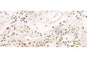 Immunohistochemistry of paraffin-embedded Human lung cancer tissue using PDS5A Polyclonal Antibody at dilution of 1:90(x200) (PDS5A antibody)