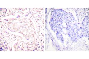 Peptide - +Immunohistochemistry analysis of paraffin-embedded human breast carcinoma tissue using FOS antibody. (c-FOS antibody  (Internal Region))