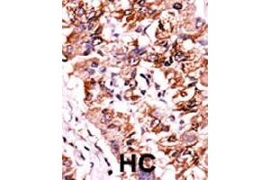 Formalin-fixed and paraffin-embedded human hepatocellular carcinoma tissue reacted with CHEK1 (phospho S317) polyclonal antibody  which was peroxidase-conjugated to the secondary antibody followed by AEC staining. (CHEK1 antibody  (pSer317))
