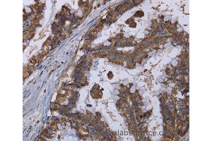 Immunohistochemistry of Human esophagus cancer using MT3 Polyclonal Antibody at dilution of 1:50