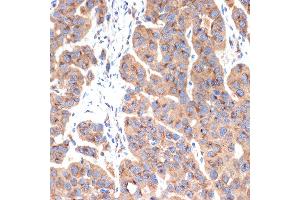 Immunohistochemistry of paraffin-embedded human esophageal cancer using G1 Rabbit mAb (ABIN7265446) at dilution of 1:100 (40x lens). (gamma 1 Adaptin antibody)