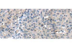 Immunohistochemistry of paraffin-embedded Human breast cancer using GLP2R Polyclonal Antibody at dilution of 1/30 (GLP2R antibody)