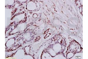 Formalin-fixed and paraffin embedded human colon carcinoma tissue labeled with Anti-FRA2/FOSL2 Polyclonal Antibody, Unconjugated (ABIN673104) at 1:200 followed by conjugation to the secondary antibody and DAB staining