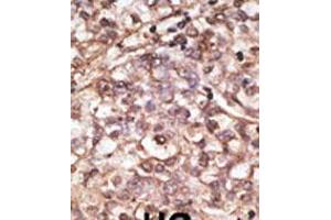 Formalin-fixed and paraffin-embedded human cancer tissue reacted with the primary antibody, which was peroxidase-conjugated to the secondary antibody, followed by DAB staining. (DKK4 antibody  (C-Term))