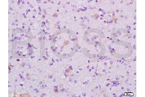 Formalin-fixed and human glioma tissue labeled with Anti-MAP1A Polyclonal Antibody (ABIN735308), Unconjugated at 1:200 followed by conjugation to the secondary antibody and DAB staining