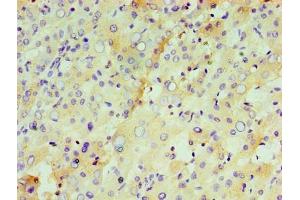 Immunohistochemistry of paraffin-embedded human liver tissue using ABIN7156608 at dilution of 1:100 (IL29 antibody  (AA 21-200))