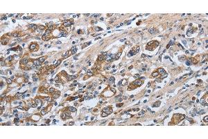 Immunohistochemistry of paraffin-embedded Human gasrtic cancer tissue using SLC34A2 Polyclonal Antibody at dilution of 1:50