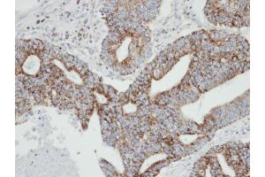 IHC-P Image Immunohistochemical analysis of paraffin-embedded human endo mitral OCVA , using RAB2A, antibody at 1:100 dilution. (RAB2A antibody  (C-Term))