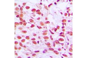 Immunohistochemical analysis of ELK1 (pS389) staining in human breast cancer formalin fixed paraffin embedded tissue section.