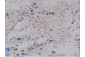 IHC-P analysis of Human Breast Cancer Tissue, with DAB staining. (DEFA4 antibody  (AA 23-97))