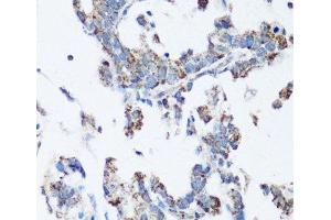 Immunohistochemistry of paraffin-embedded Human gastric cancer using SRC Polyclonal Antibody at dilution of 1:100 (40x lens). (Src antibody)
