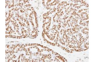 IHC-P Image Immunohistochemical analysis of paraffin-embedded human breast cancer, using XPC, antibody at 1:250 dilution. (XPC antibody  (C-Term))