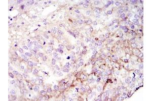 Immunohistochemical analysis of paraffin-embedded cervices tumour using FAK mouse mAb with DAB staining (FAK antibody)
