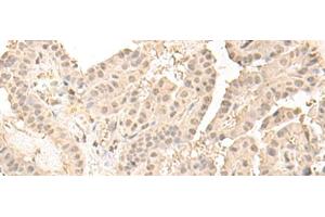 Immunohistochemistry of paraffin-embedded Human thyroid cancer tissue using ZGPAT Polyclonal Antibody at dilution of 1:35(x200) (ZGPAT antibody)