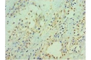 Immunohistochemistry of paraffin-embedded human breast cancer using ABIN7156537 at dilution of 1:100