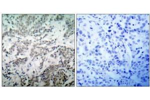 Immunohistochemical analysis of paraffin-embedded human breast carcinoma tissue using p53 (Ab-15) antibody (E021085). (p53 antibody)