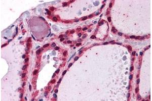 Human Thyroid: Formalin-Fixed, Paraffin-Embedded (FFPE) (IRAK1 antibody  (AA 530-693))