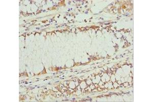 Immunohistochemistry of paraffin-embedded human colon cancer using ABIN7163636 at dilution of 1:100 (PLEKHA1 antibody  (AA 285-404))