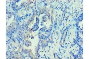 Immunohistochemistry of paraffin-embedded human lung cancer using ABIN7142680 at dilution of 1:100 (PRKAB2 antibody  (AA 1-272))