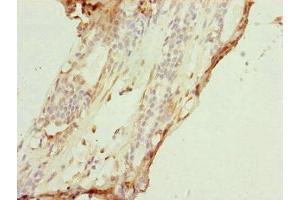 Immunohistochemistry of paraffin-embedded human breast cancer using ABIN7149183 at dilution of 1:100 (COX7A2L antibody  (AA 1-114))