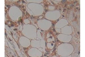 Detection of TTK in Human Skin cancer Tissue using Polyclonal Antibody to TTK Protein Kinase (TTK)
