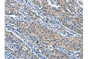 The image on the left is immunohistochemistry of paraffin-embedded Human gastric cancer tissue using ABIN7130004(KLF7 Antibody) at dilution 1/60, on the right is treated with fusion protein. (KLF7 antibody)