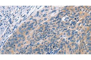 Immunohistochemistry of paraffin-embedded Human cervical cancer tissue using CUL7 Polyclonal Antibody at dilution 1:50 (Cullin 7 antibody)
