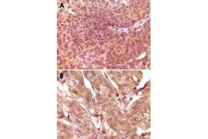 Immunohistochemical analysis of paraffin-embedded human bladder carcinoma (A) and breast carcinoma (B), showing nuclear and cytoplasmic localization using SRA1 monoclonal antibody, clone 7H1G1  with DAB staining.